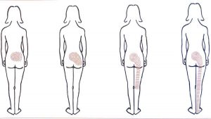 disegno di figura femminile con Processo temporale dell'infiammazione lombare