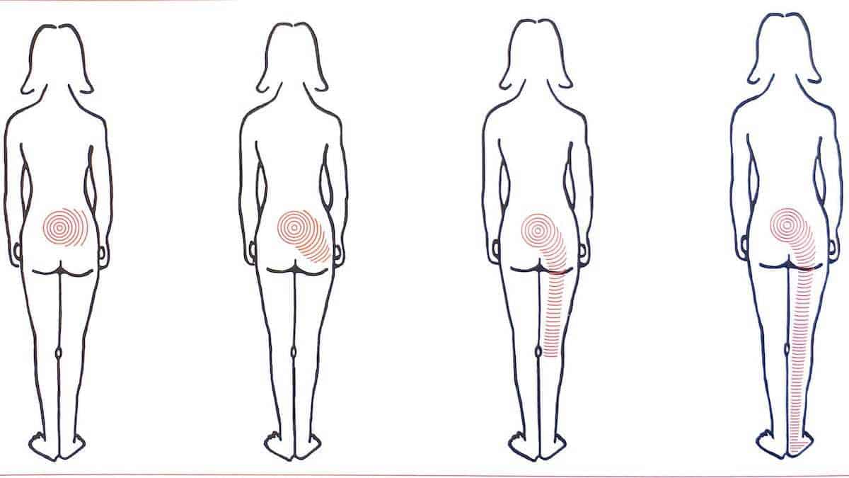 disegno di figura femminile con Processo temporale dell'infiammazione lombare