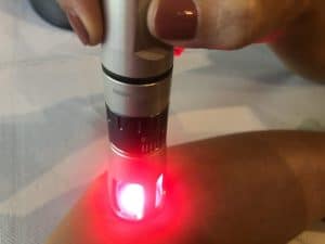 terapia laser in un punto del braccio